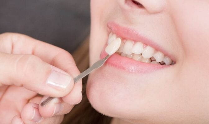 Dịch vụ bọc răng sứ Thái Bình uy tín hiện nay