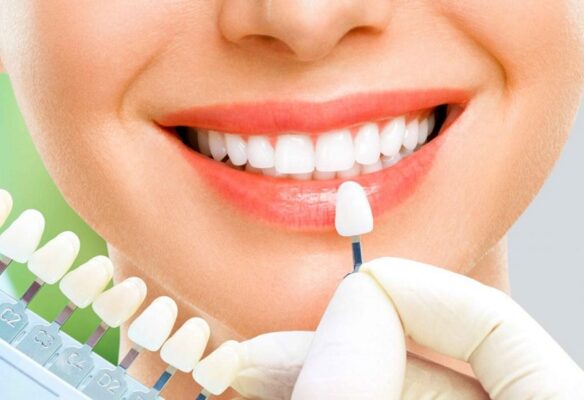 Phương pháp làm răng sứ thẩm mỹ Thái Bình