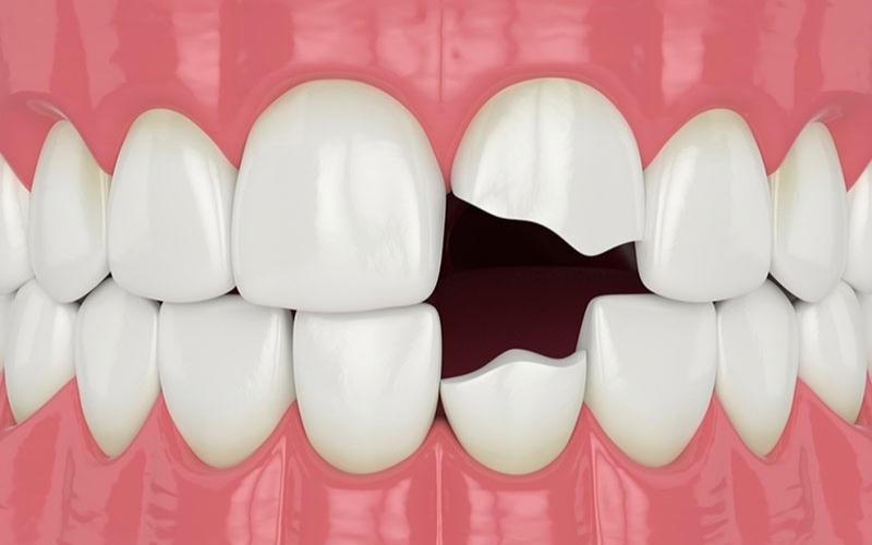 Bỏ túi những lưu ý khi bọc răng sứ tại Thái Bình