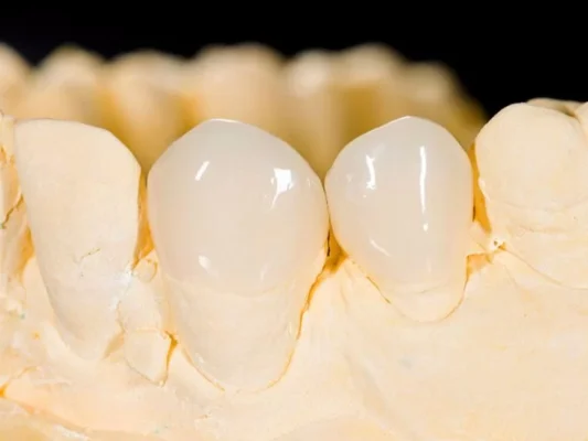 Quy trình trồng răng sứ chuẩn xác, an toàn & không đau