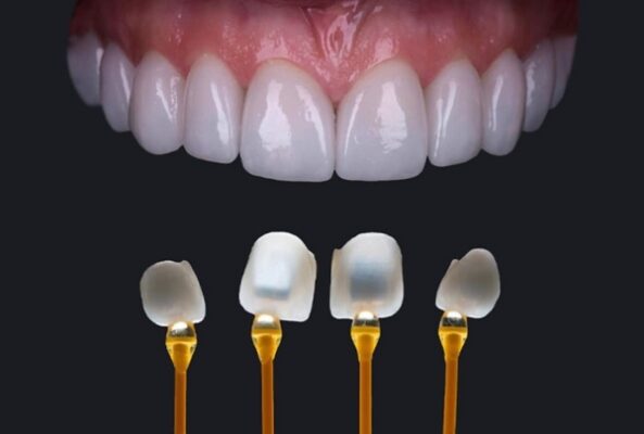 Dán sứ Smart Veneer – Dán sứ một lần đẹp trọn đời