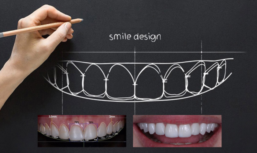 Công nghệ thiết kế nụ cười Thái Bình - Bước tiến mới trong nha khoa hiện đại