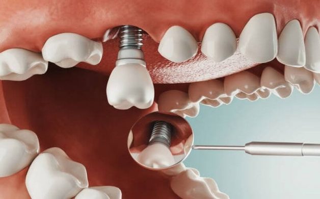 Phương pháp hiện đại trồng răng implant bằng máng hướng dẫn Thái Bình