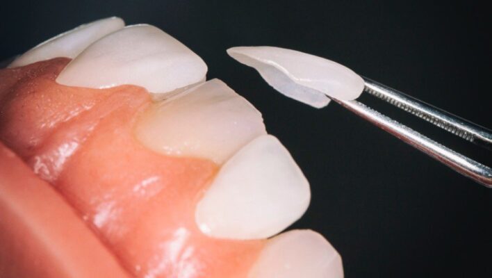 Smart Veneer – Công nghệ dán sứ hoàn toàn mới giảm thiểu xâm lấn