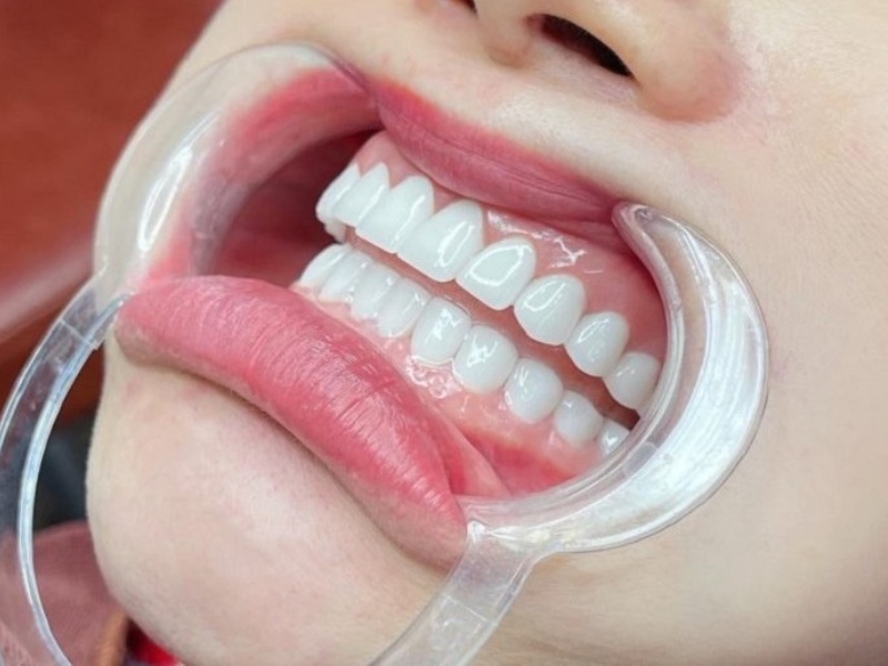 Bọc răng sứ Thái Bình là gì Khi nào nên bọc răng sứ