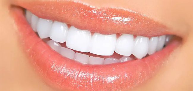 Ưu điểm của bọc răng sứ Thái Bình mang lại 2 Bọc răng sứ mang lại nụ cười tự tin