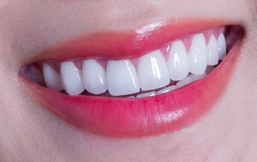 Bọc răng sứ Thái Bình - Giải pháp cho nụ cười hoàn hảo tự tin