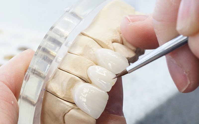 Quy trình Labo sản xuất răng sứ Thái Bình