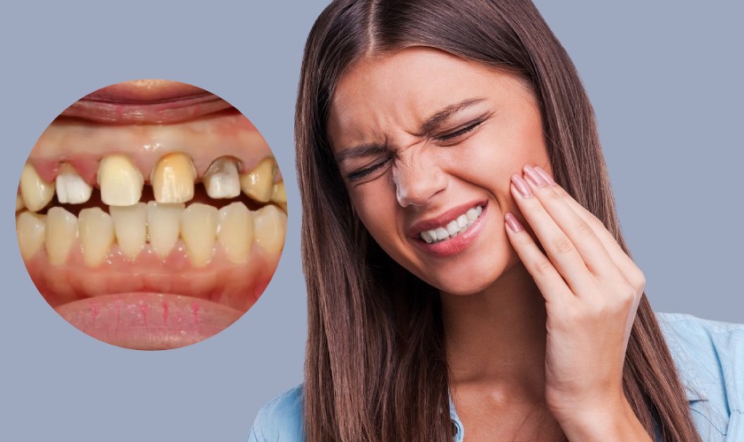 Bọc răng sứ Thái Bình giải pháp hoàn hảo cho nụ cười tỏa sáng 3 Khi nào cần bọc răng sứ?