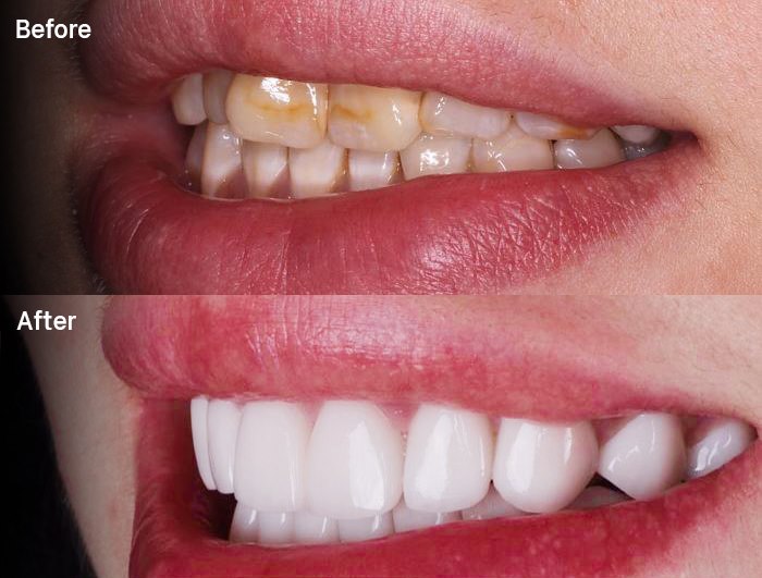 Bọc răng sứ Thái Bình giải pháp hoàn hảo cho nụ cười tỏa sáng 4 Nha Khoa Ngọc là địa chỉ uy tín nổi bật với dịch vụ bọc răng sứ Thái Bình