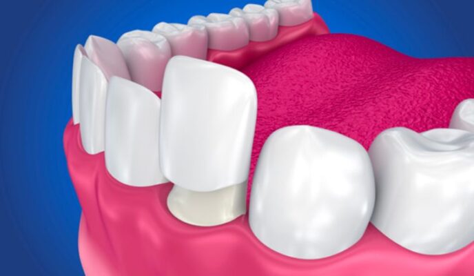 Những trường hợp nên bọc răng sứ Thái Bình