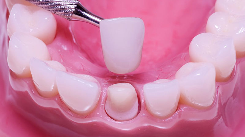 Bọc răng sứ Thái Bình giải pháp hoàn hảo cho nụ cười tỏa sáng 1 Dịch vụ bọc răng sứ Thái Bình chất lượng giúp bạn tìm lại nụ cười tỏa sáng tràn đầy tự tin
