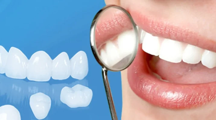 Bọc răng sứ Thái Bình mang lại nụ cười tự tin và tỏa sáng