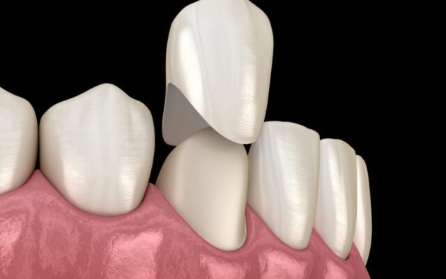 Khám phá dịch vụ bọc răng sứ Thái Bình