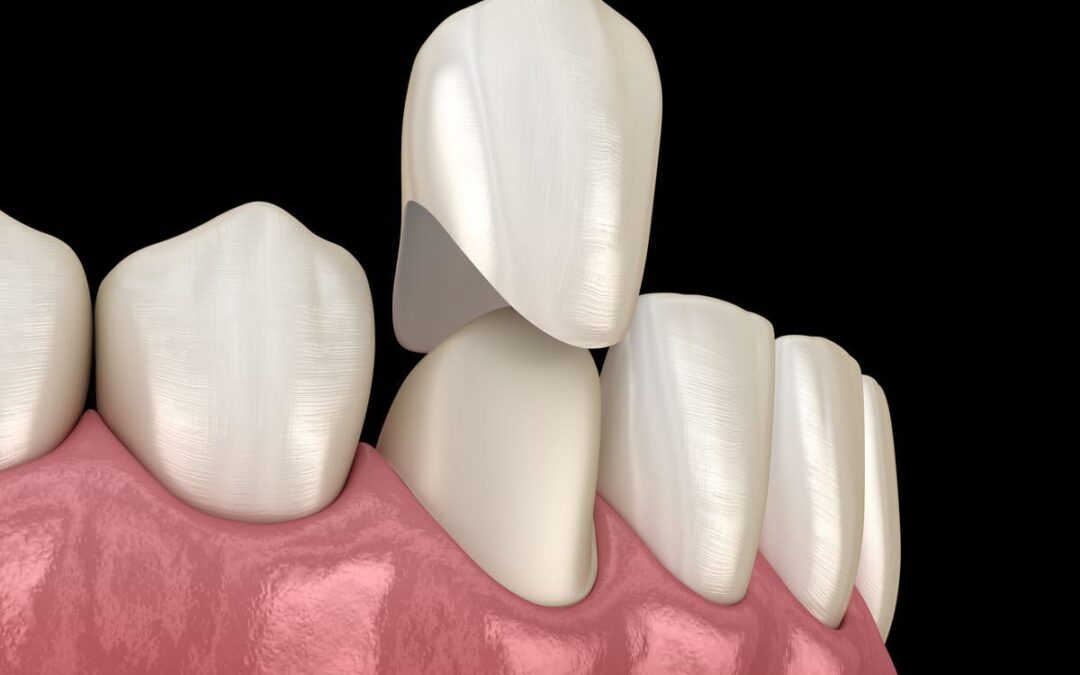 Khám phá dịch vụ bọc răng sứ Thái Bình