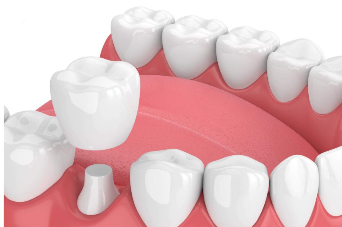 Phương pháp bọc răng sứ Thái Bình mang lại nụ cười tự tin