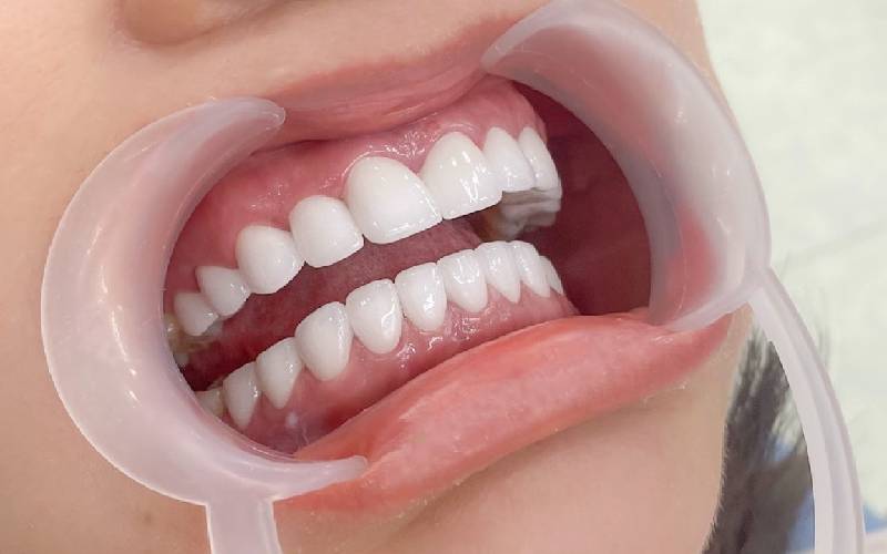 Quy trình bọc răng sứ Thái Bình