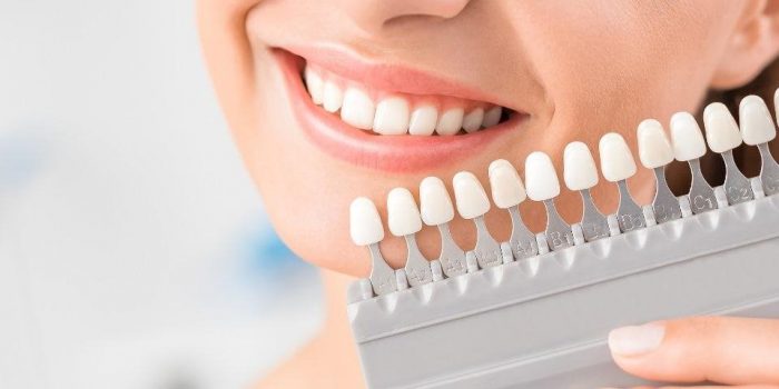 Tiêu chí đánh giá địa chỉ bọc răng sứ Thái Bình uy tín