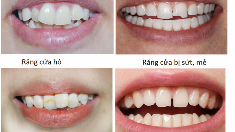 Những dấu hiệu cần bọc răng sứ Thái Bình