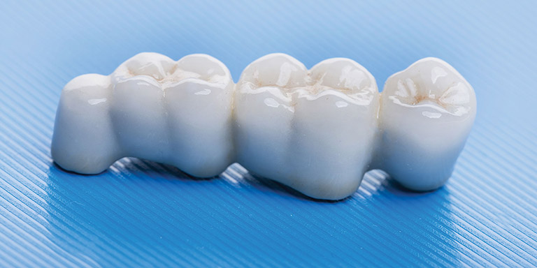 Các phương thức bọc răng sứ phổ biến hiện nay