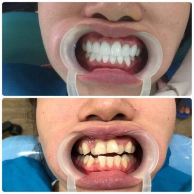 bọc răng sứ Thái Bình