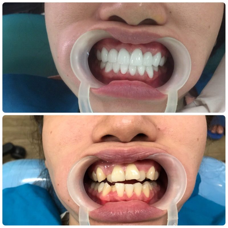 bọc răng sứ Thái Bình