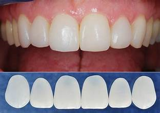 bọc răng sứ Thái Bình