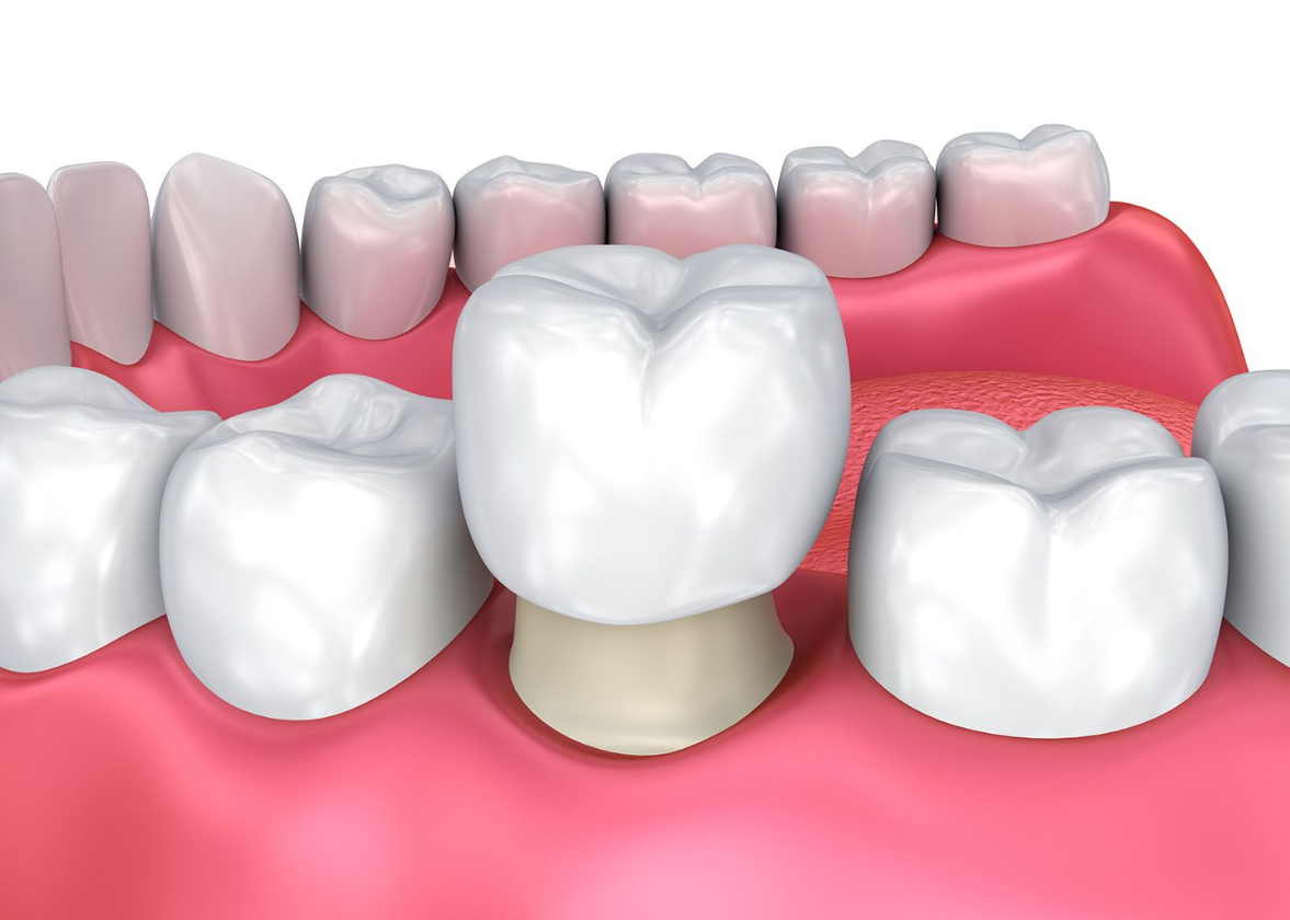 Bọc răng sứ Thái Bình Hành trình đến với nụ cười rạng rỡ