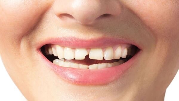 Giải đáp chi phí hàn răng mẻ Hưng Yên – Tốn bao nhiêu tiền cho một lần hàn