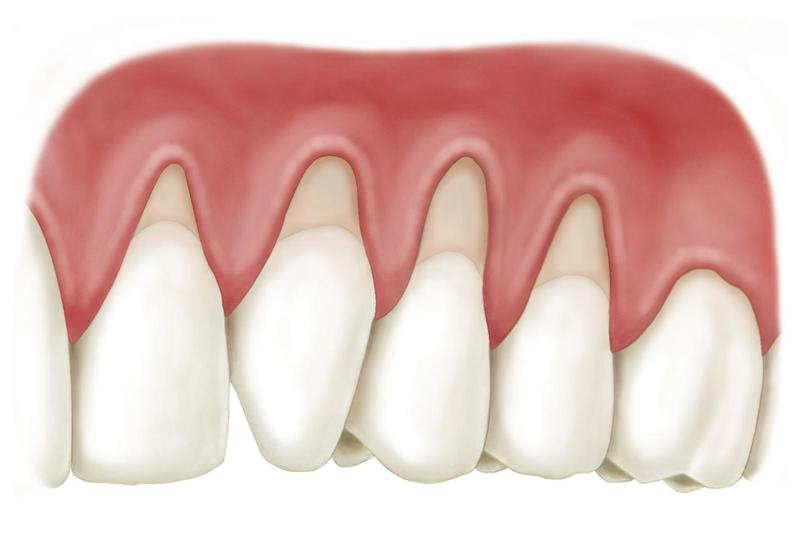 Hàn chân răng Hưng Yên Khi nào cần phải thực hiện