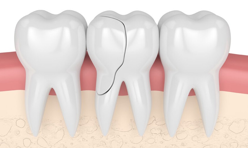 Hàn răng bị vỡ Thái Bình: An toàn nhanh chóng hiệu quả 2 Hàn răng bị vỡ Thái Bình An toàn nhanh chóng hiệu quả