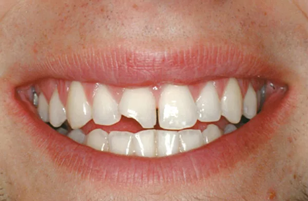 Hàn răng bị mẻ Hưng Yên: Giải pháp hiệu quả khôi phục nụ cười 1 Răng bị sứt mẻ do đâu