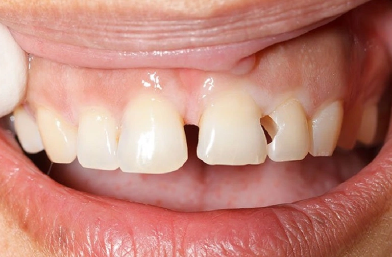 Những câu hỏi thường gặp về hàn răng bị mẻ Thái Bình 1 Sâu răng cũng là lý do khiến răng bị sứt mẻ