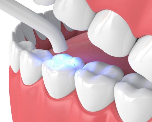 Tìm hiểu dịch vụ hàn răng Hưng Yên Khi nào nên thực hiện