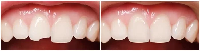 Yếu tố ảnh hưởng đến chi phí hàn răng mẻ Thái Bình