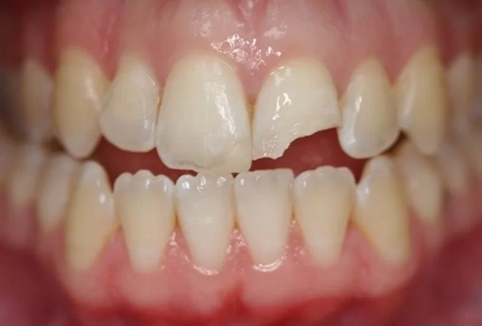 Chi tiết quy trình hàn răng cửa Thái Bình từ A đến Z