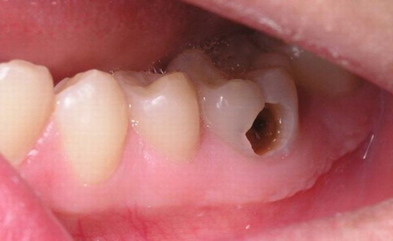 Dấu hiệu của răng sâu vào tủy
