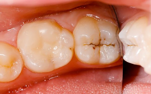 Dấu hiệu của răng sâu