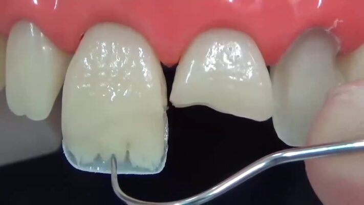 Hàn răng mẻ Hưng Yên có đau không Quy trình thực hiện như thế nào