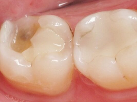 Hàn răng sâu vào tủy Thái Bình Giải đáp thắc mắc từ nha sĩ