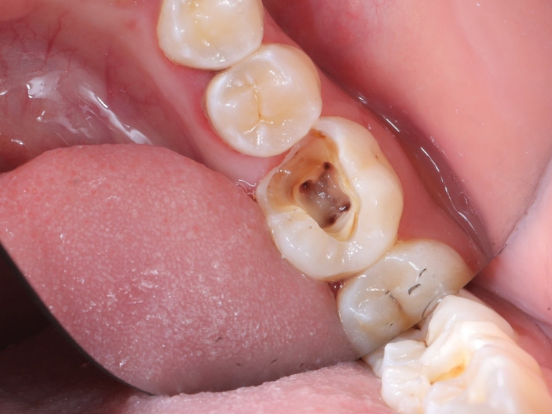 Hàn răng sâu vào tủy Thái Bình - Giải đáp thắc mắc từ nha sĩ