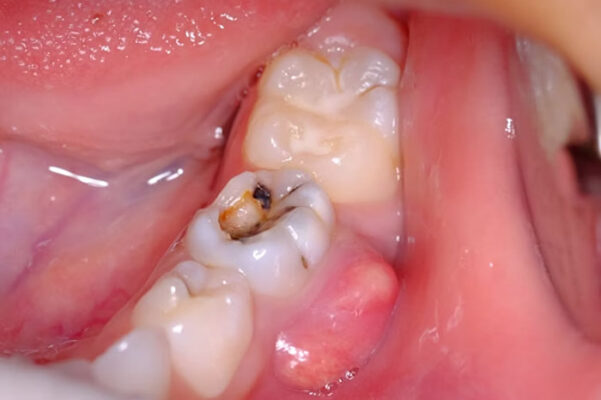 Hàn răng số 8 Thái Bình - Tìm hiểu quy trình điều trị như thế nào?