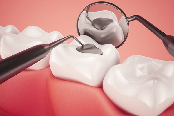 Hàn răng vĩnh viễn Thái Bình - Ưu điểm và những lưu ý khi thực hiện