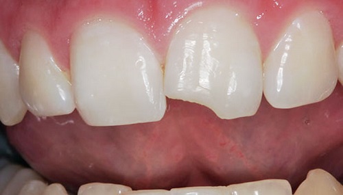 Kinh nghiệm chọn địa chỉ hàn răng mẻ Thái Bình uy tín