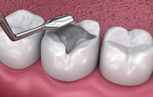 Những điều cần cần biết về hàn răng fuji Thái Bình