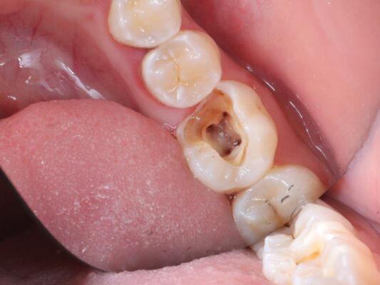 Những lưu ý cần biết khi hàn răng sâu vào tủy Hưng Yên