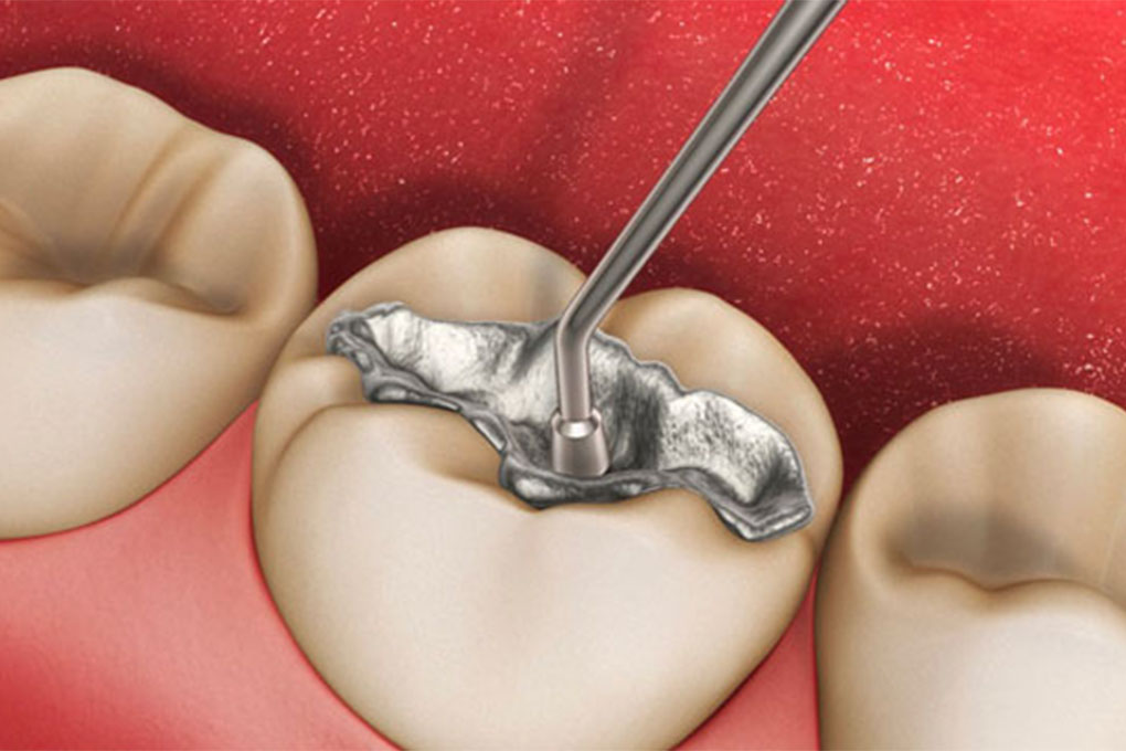 Quy trình hàn răng vĩnh viễn