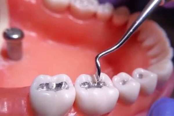 Top nha khoa hàn răng vĩnh viễn Hưng Yên uy tín