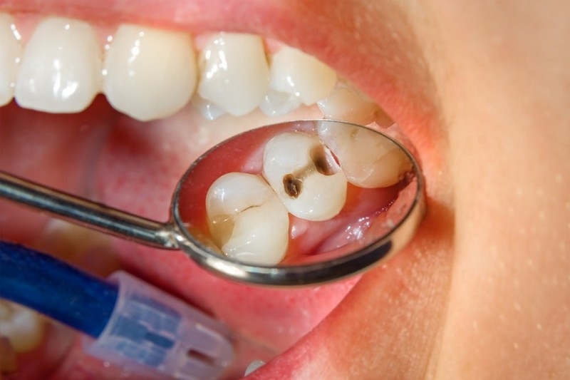Cập nhật giá hàn răng Thái Bình mới nhất 2025 1 Các yếu tố ảnh hưởng đến giá hàn răng Thái Bình