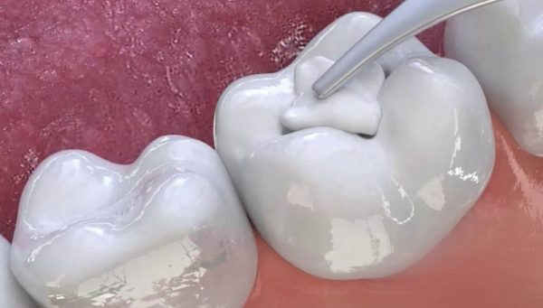 Hàn răng có bền không? Yếu tố quyết định độ bền miếng trám 2 Các yếu tố quyết định độ bền của miếng trám
